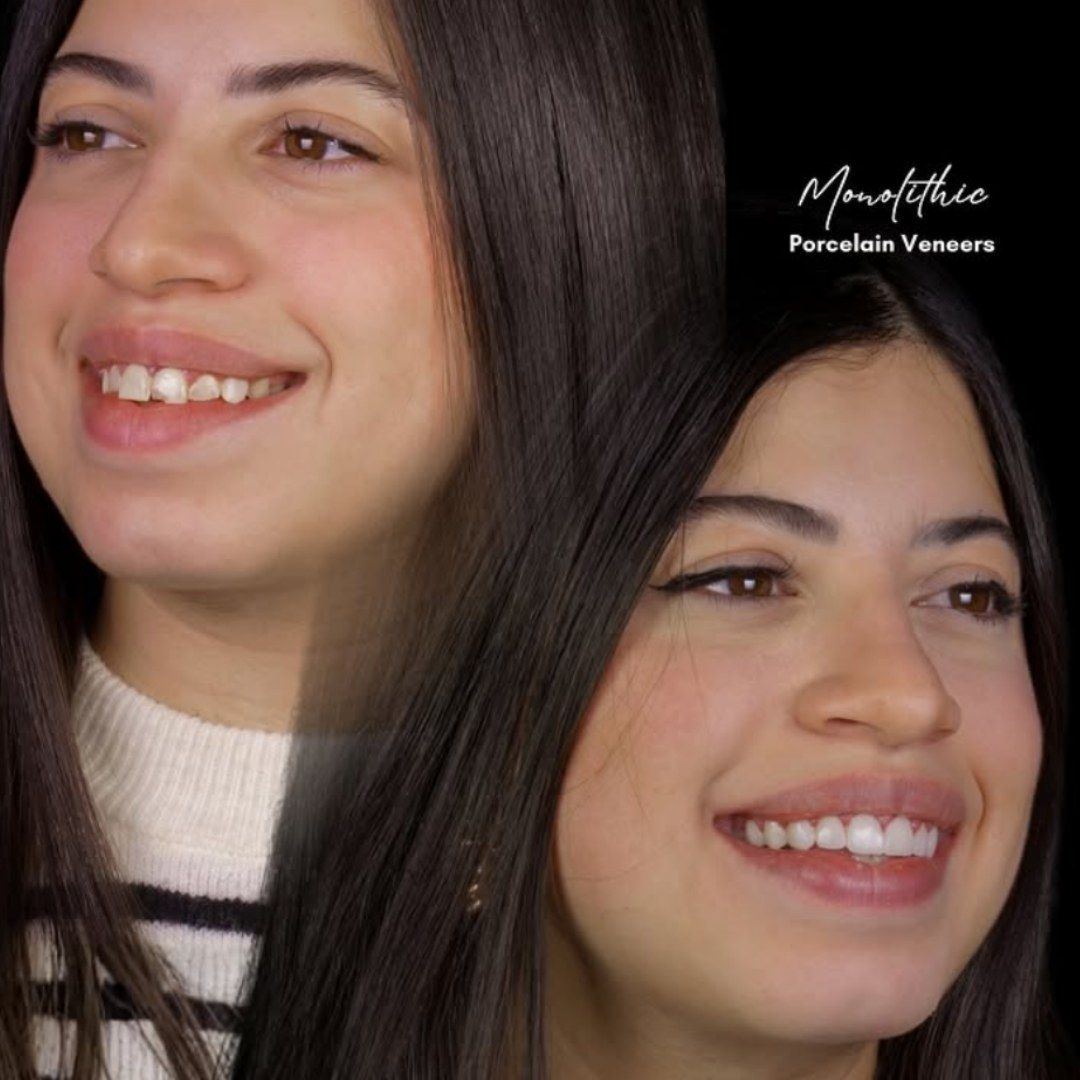 Smile transformation — real patient of Andreina Jativa DMD