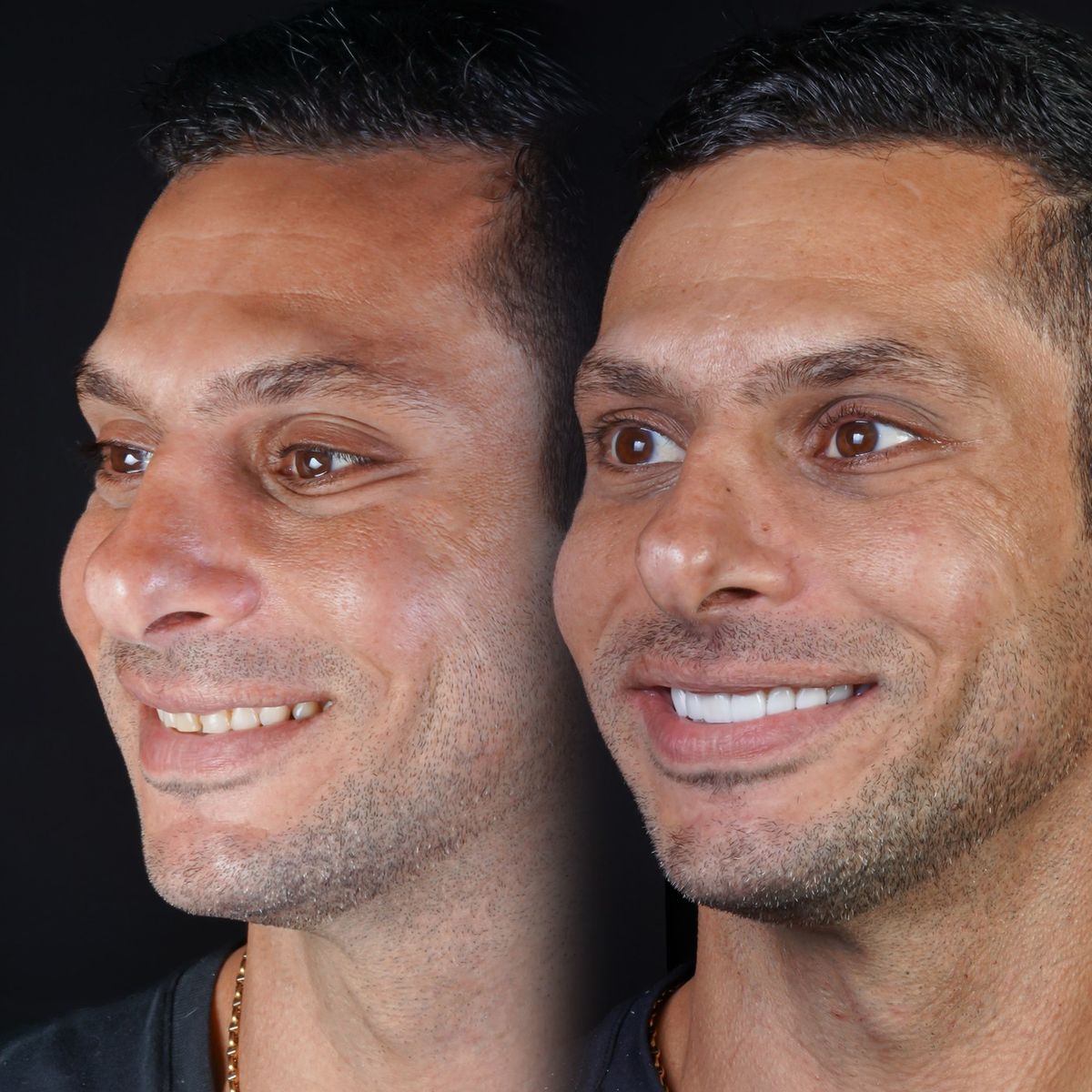 Smile transformation — real patient of Andreina Jativa DMD