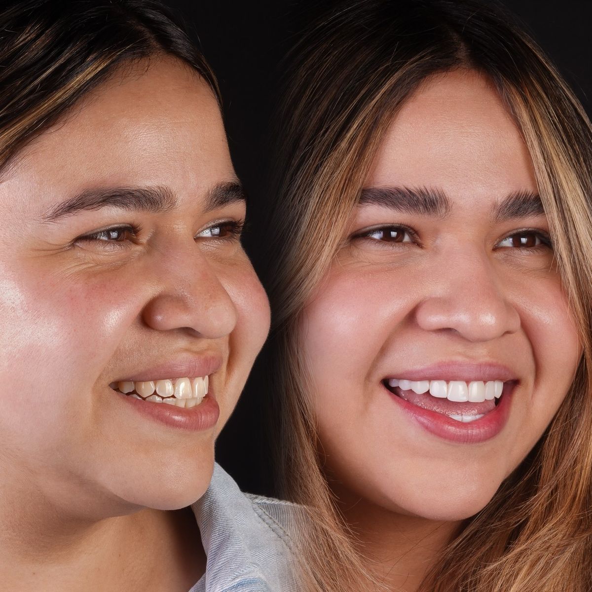 Smile transformation — real patient of Andreina Jativa DMD