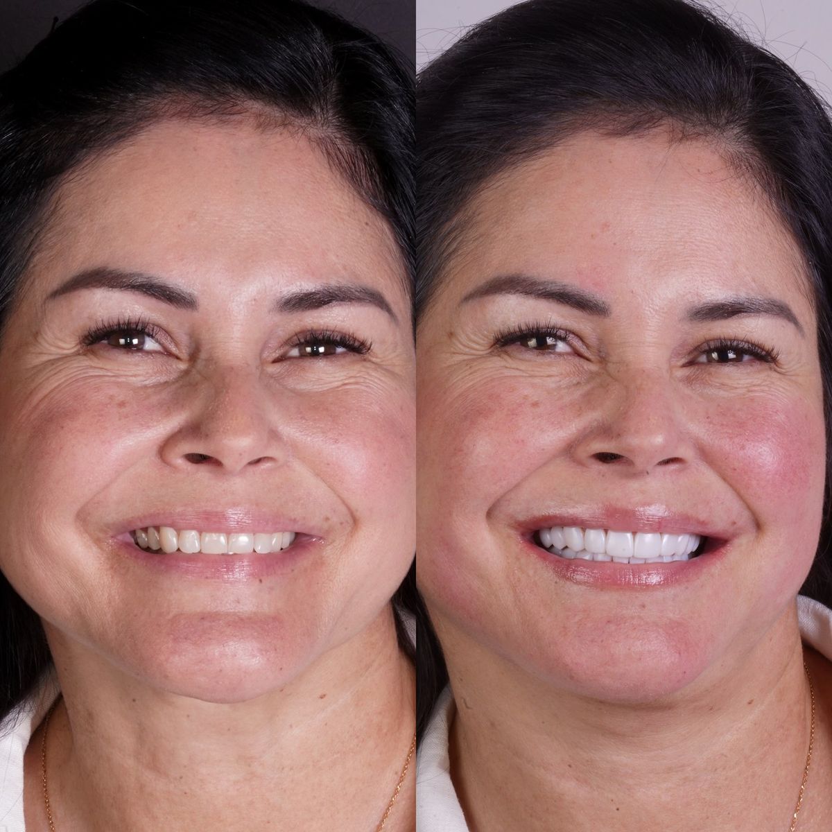 Smile transformation — real patient of Andreina Jativa DMD