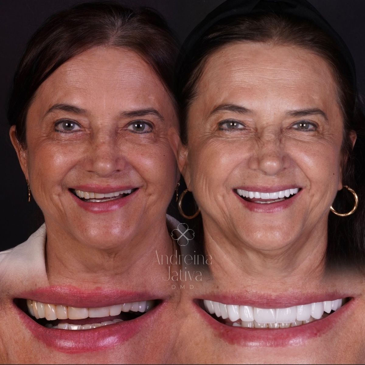 Smile transformation — real patient of Andreina Jativa DMD