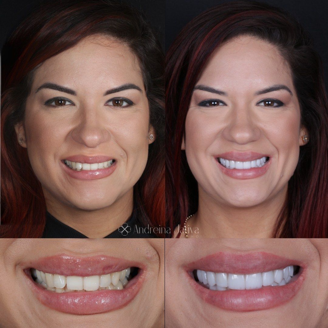 Smile transformation — real patient of Andreina Jativa DMD