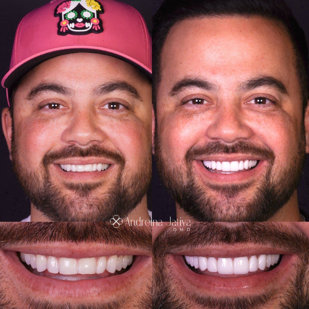 Smile transformation — real patient of Andreina Jativa DMD