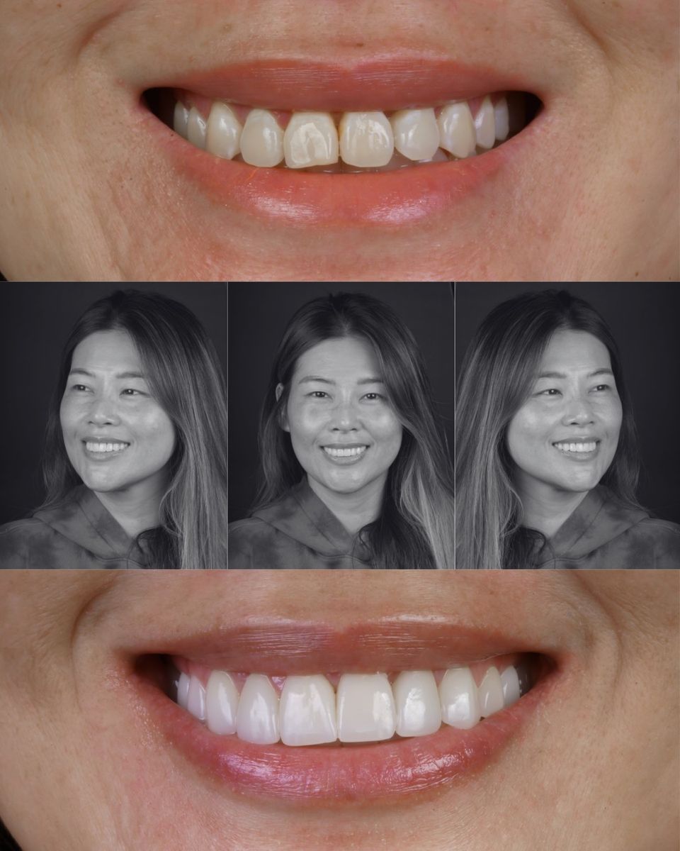 Smile transformation — real patient of Andreina Jativa DMD