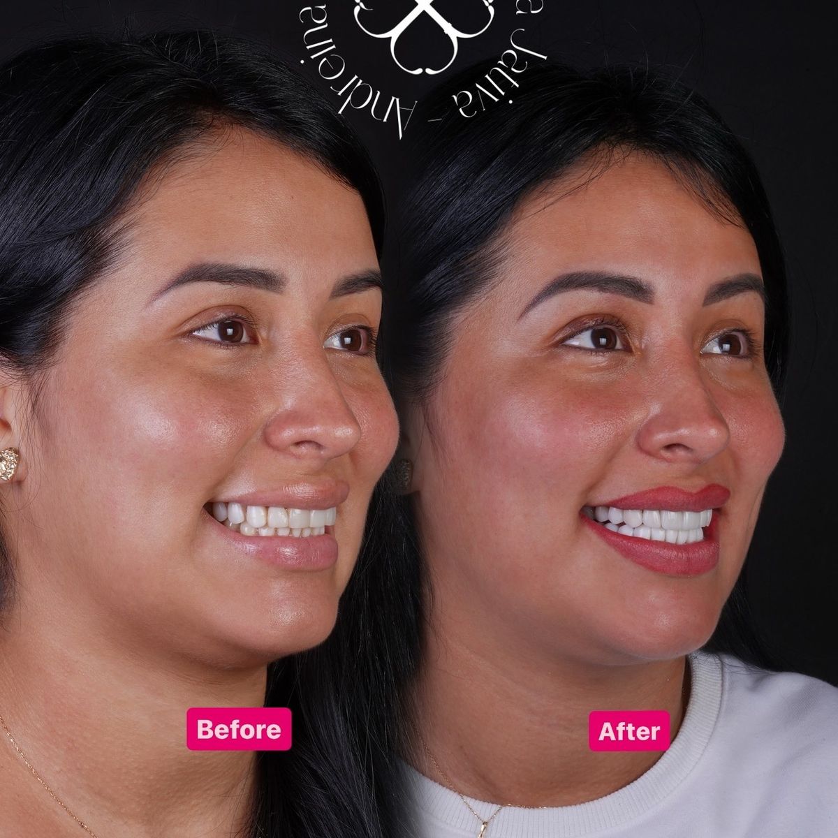 Smile transformation — real patient of Andreina Jativa DMD
