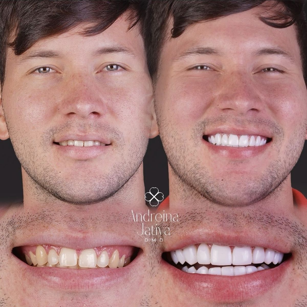 Smile transformation — real patient of Andreina Jativa DMD