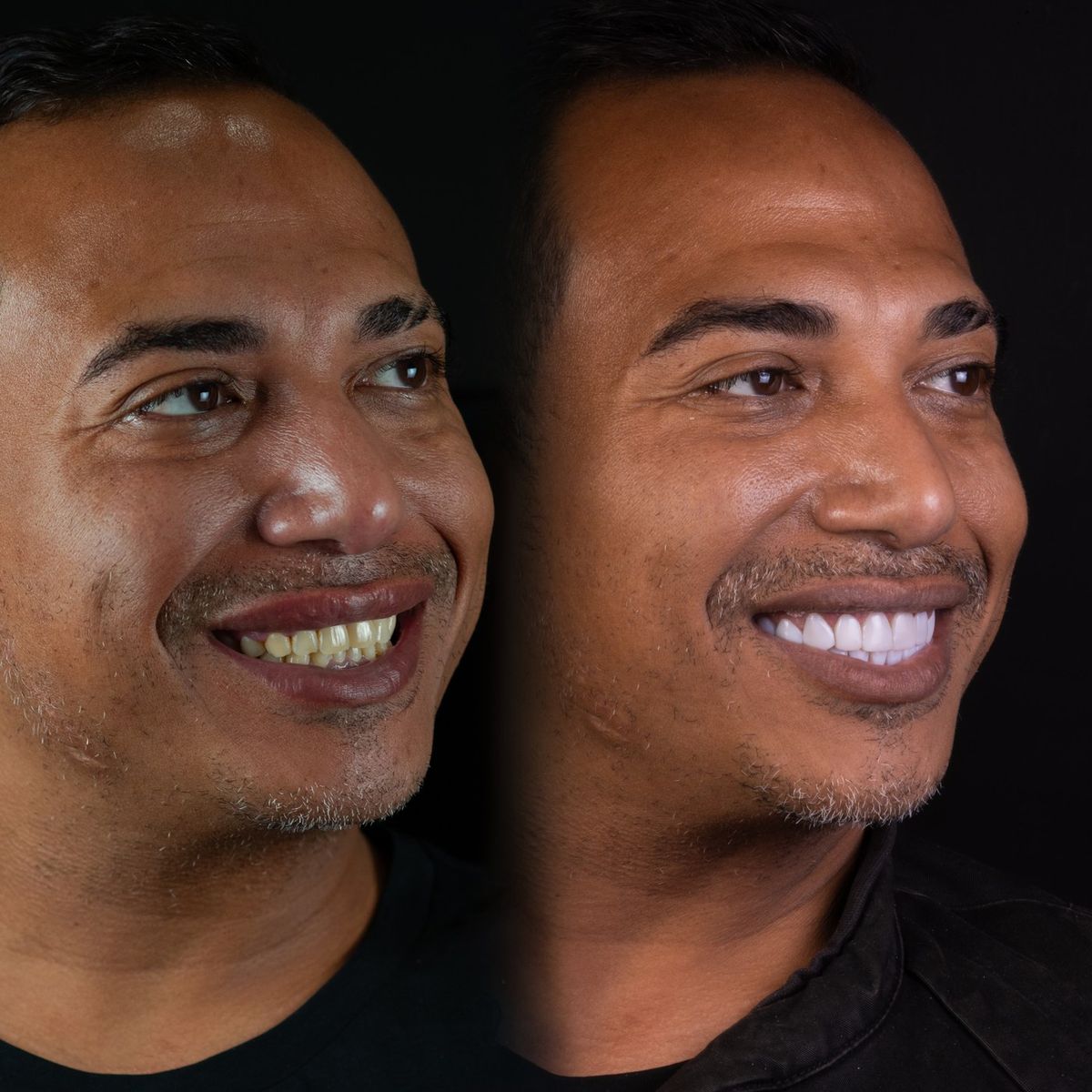Smile transformation — real patient of Andreina Jativa DMD