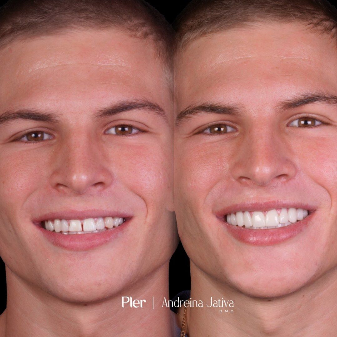 Smile transformation — real patient of Andreina Jativa DMD