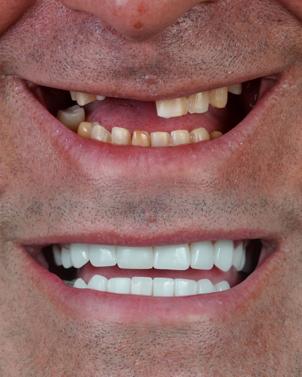 Smile transformation — real patient of Andreina Jativa DMD