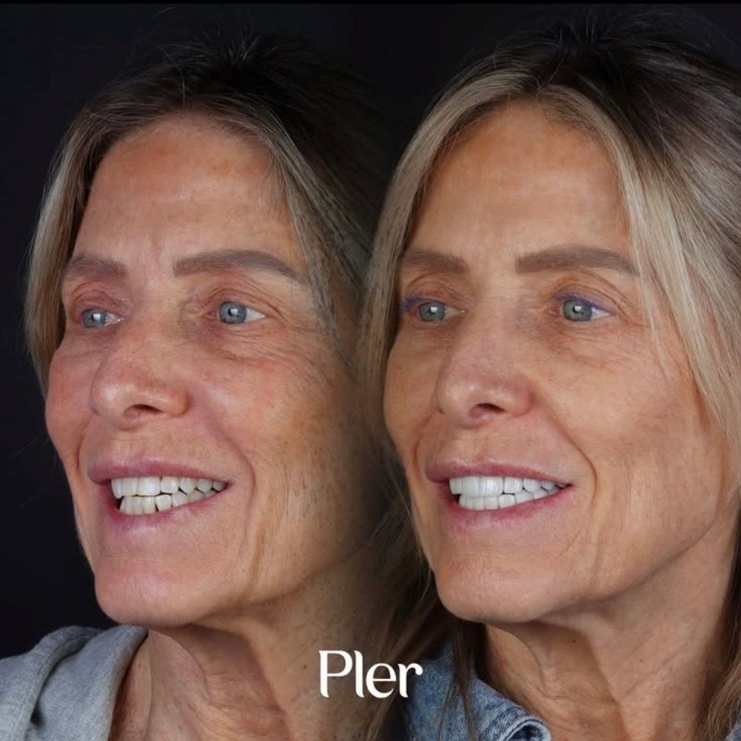 Smile transformation — real patient of Andreina Jativa DMD