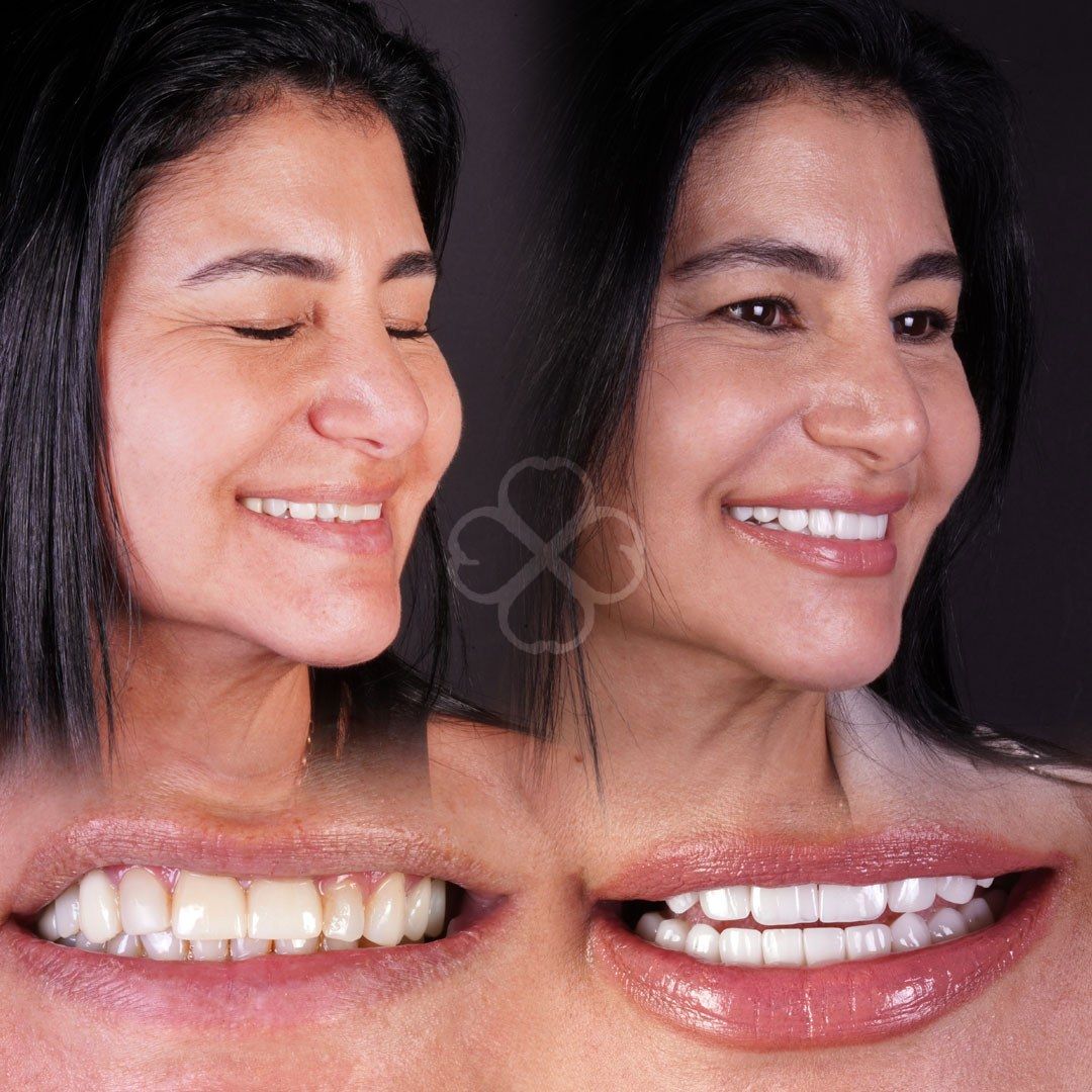 Smile transformation — real patient of Andreina Jativa DMD