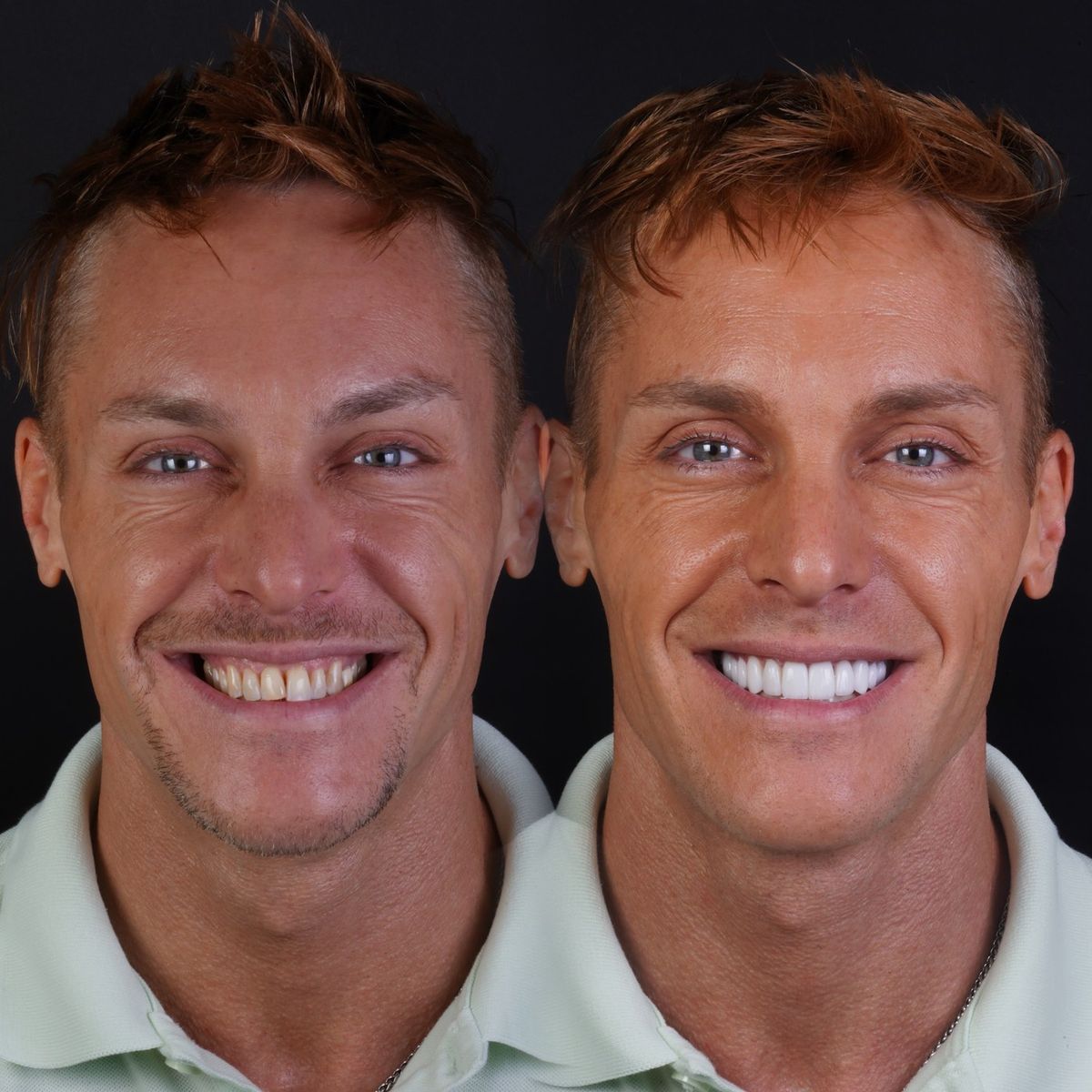 Smile transformation — real patient of Andreina Jativa DMD
