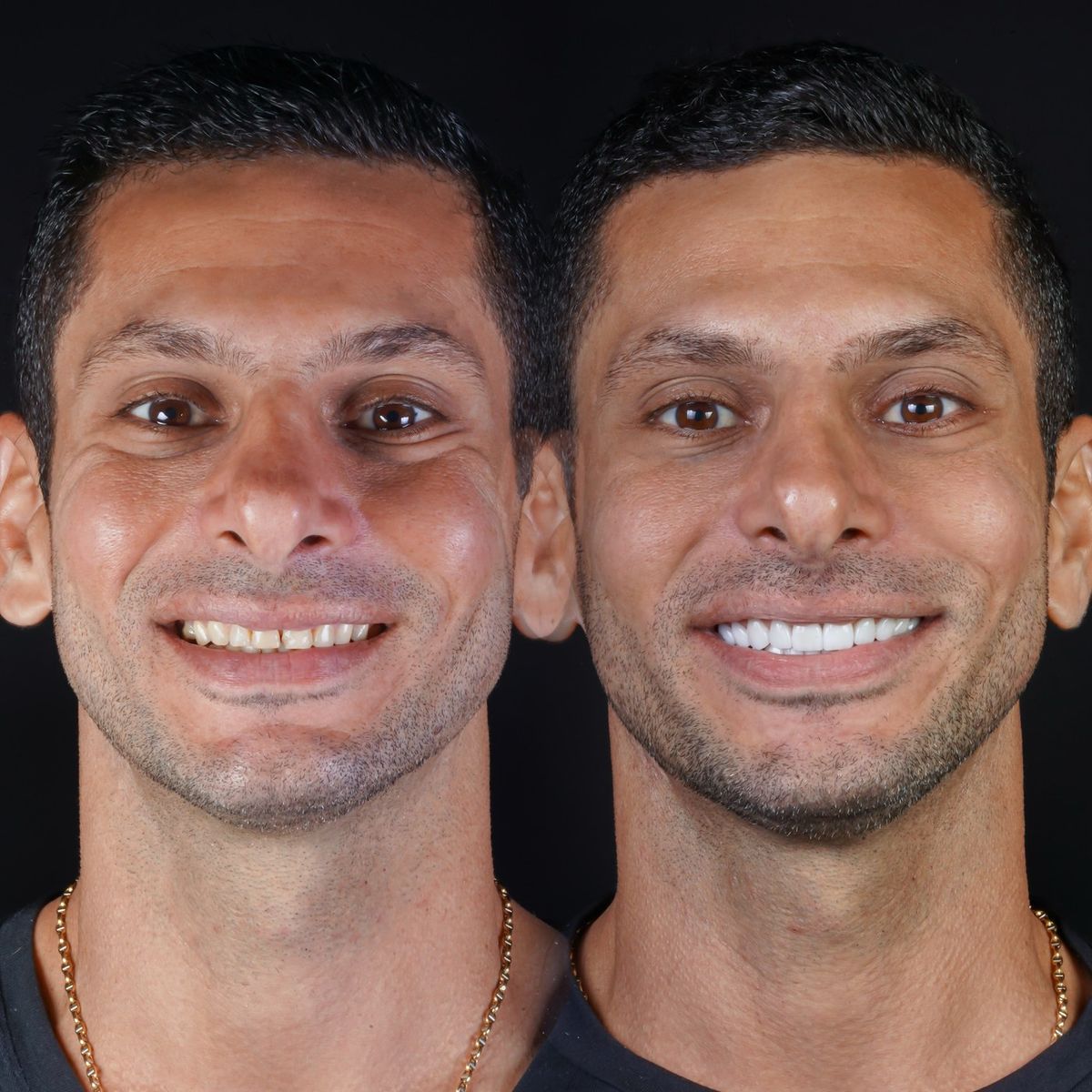 Smile transformation — real patient of Andreina Jativa DMD