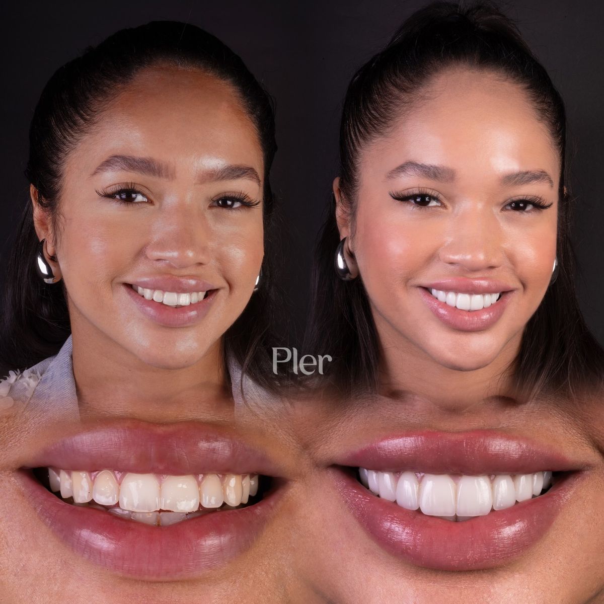 Smile transformation — real patient of Andreina Jativa DMD