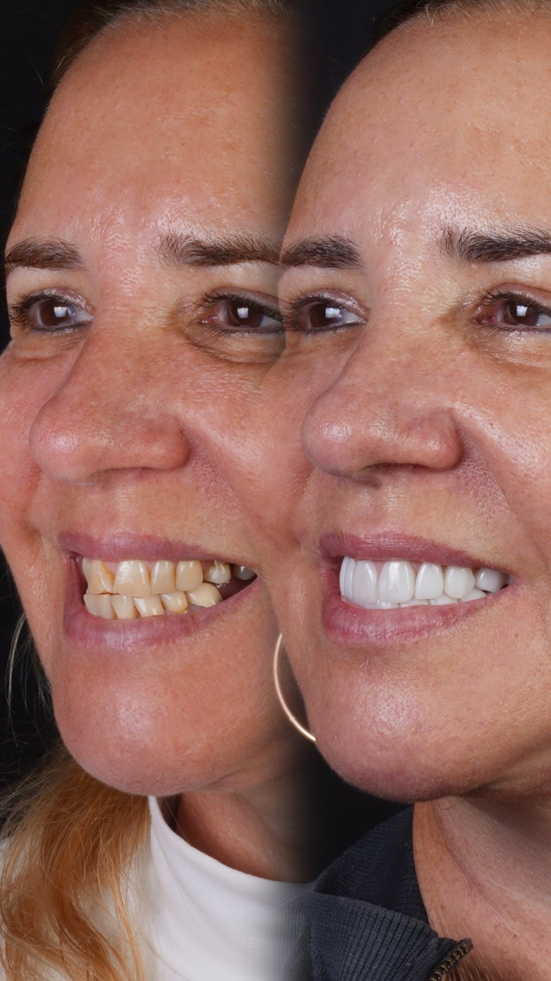 Smile transformation — real patient of Andreina Jativa DMD