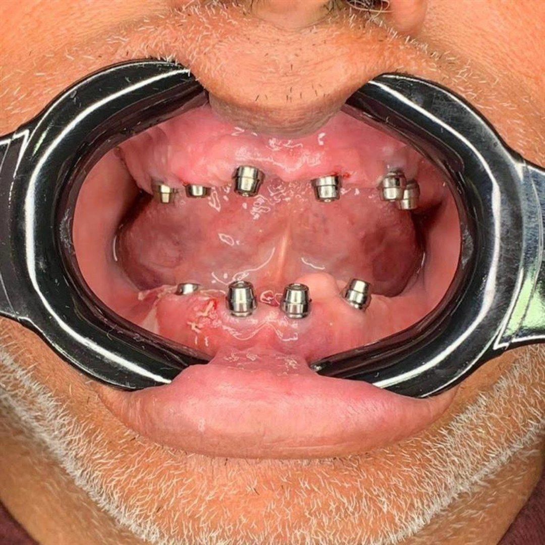 Before All-on-X · Full arch