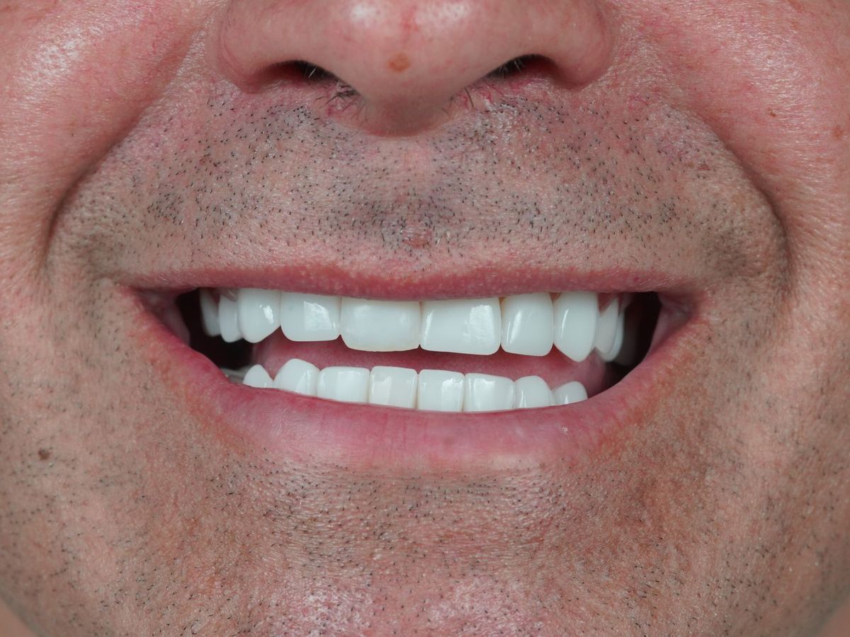 After Dental Implant