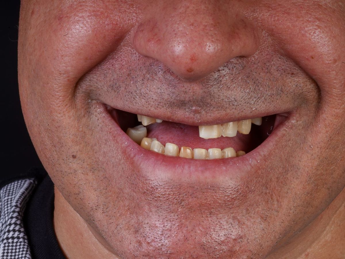 Before Dental Implant