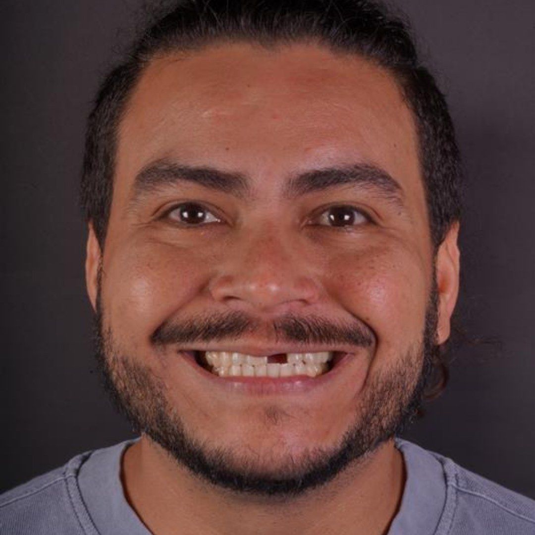 Before Dental Implant