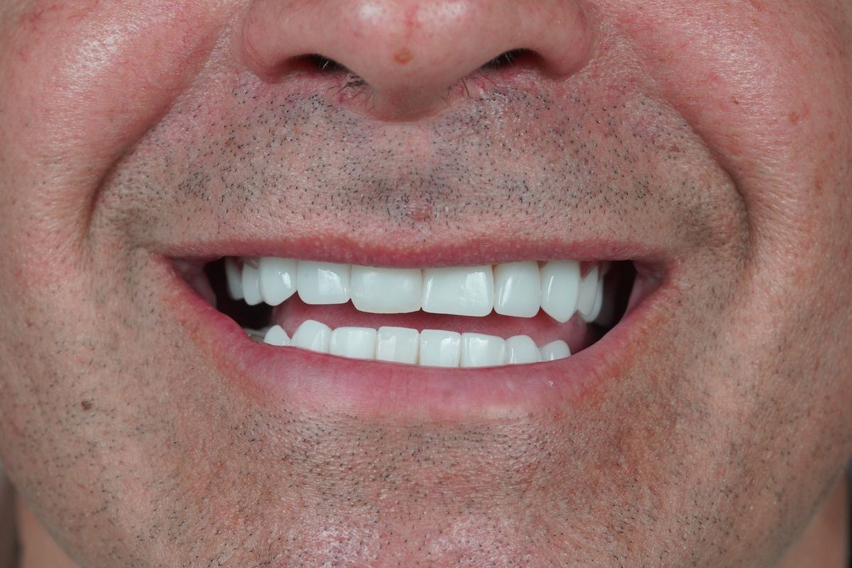 After Dental Implant