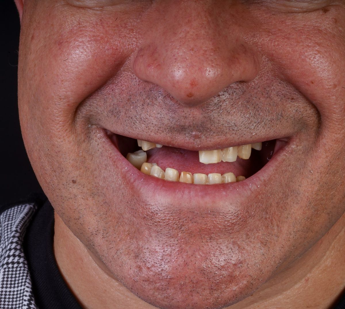 Before Dental Implant