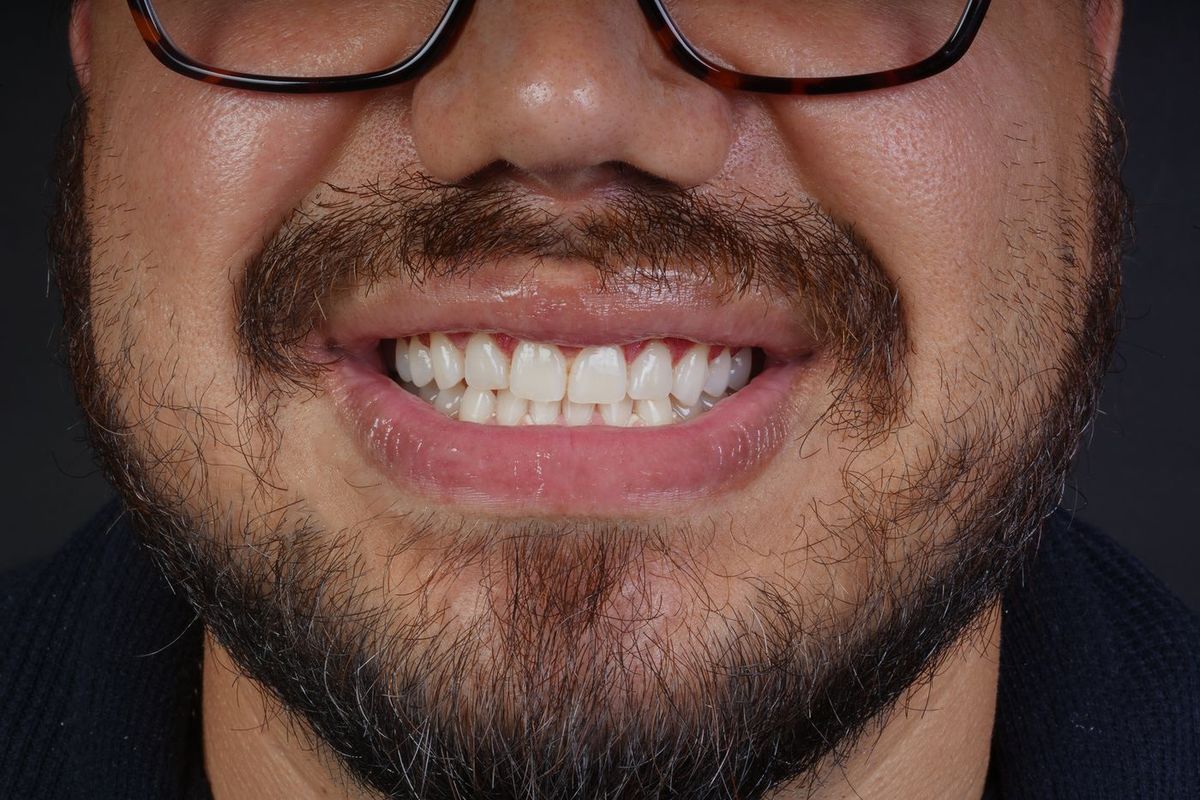 After Gingivectomy · Gum contour