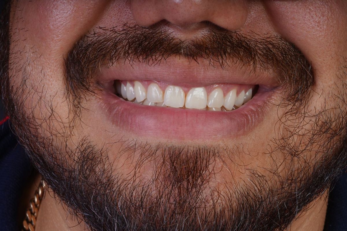 Before Gingivectomy · Gum contour