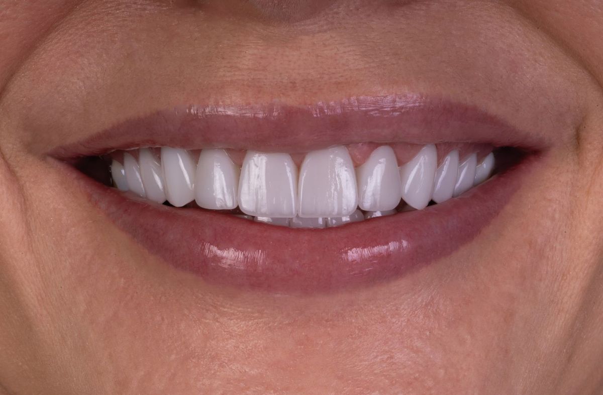 After Porcelain Veneers