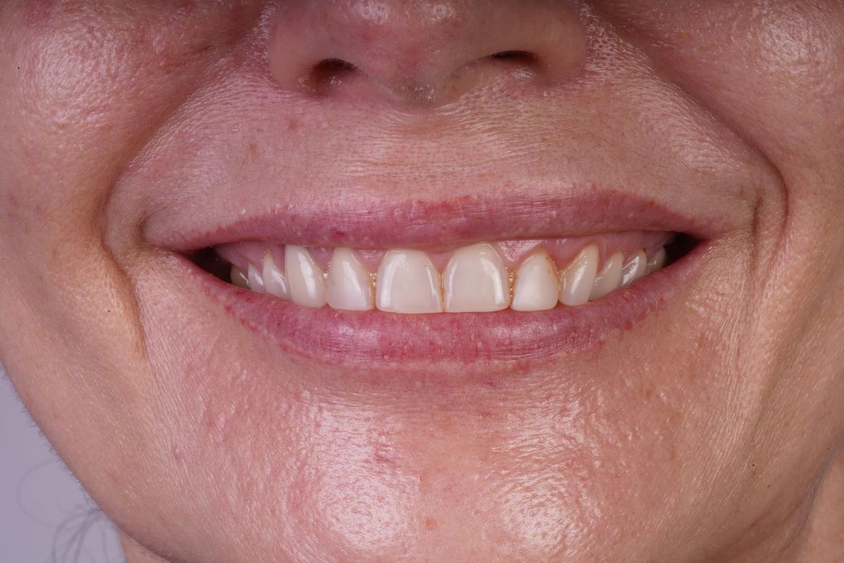 Before Porcelain Veneers