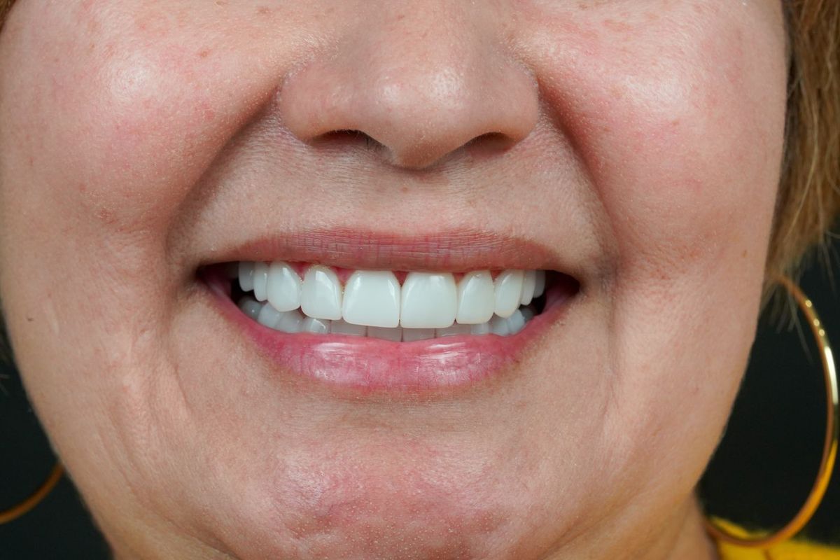 After Porcelain Veneers