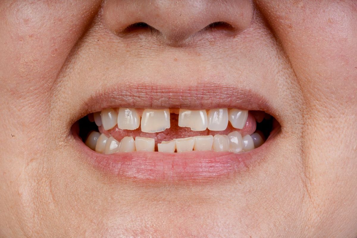Before Porcelain Veneers