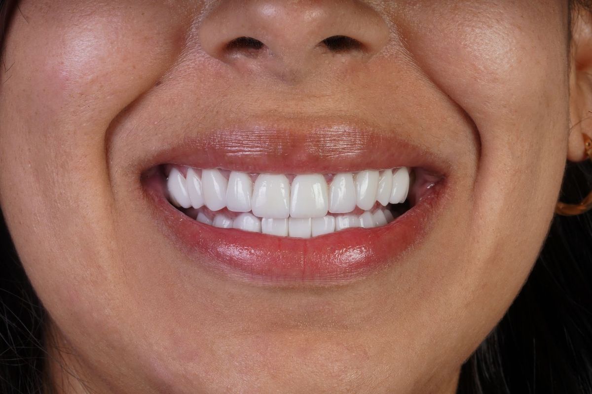 After Porcelain Veneers