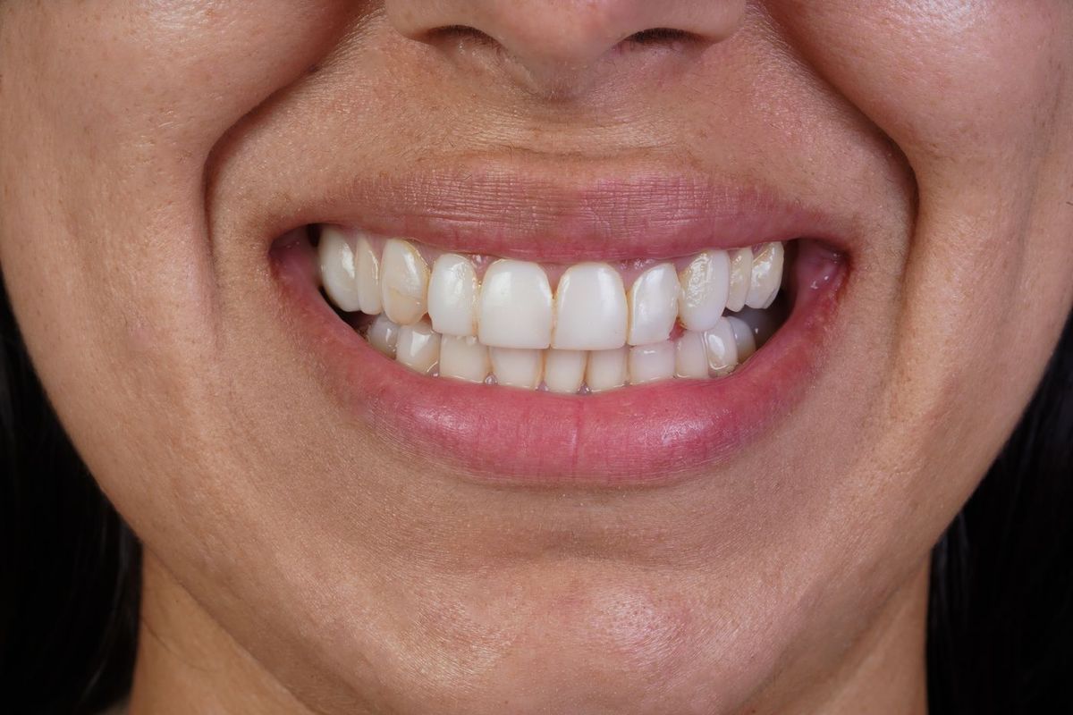 Before Porcelain Veneers