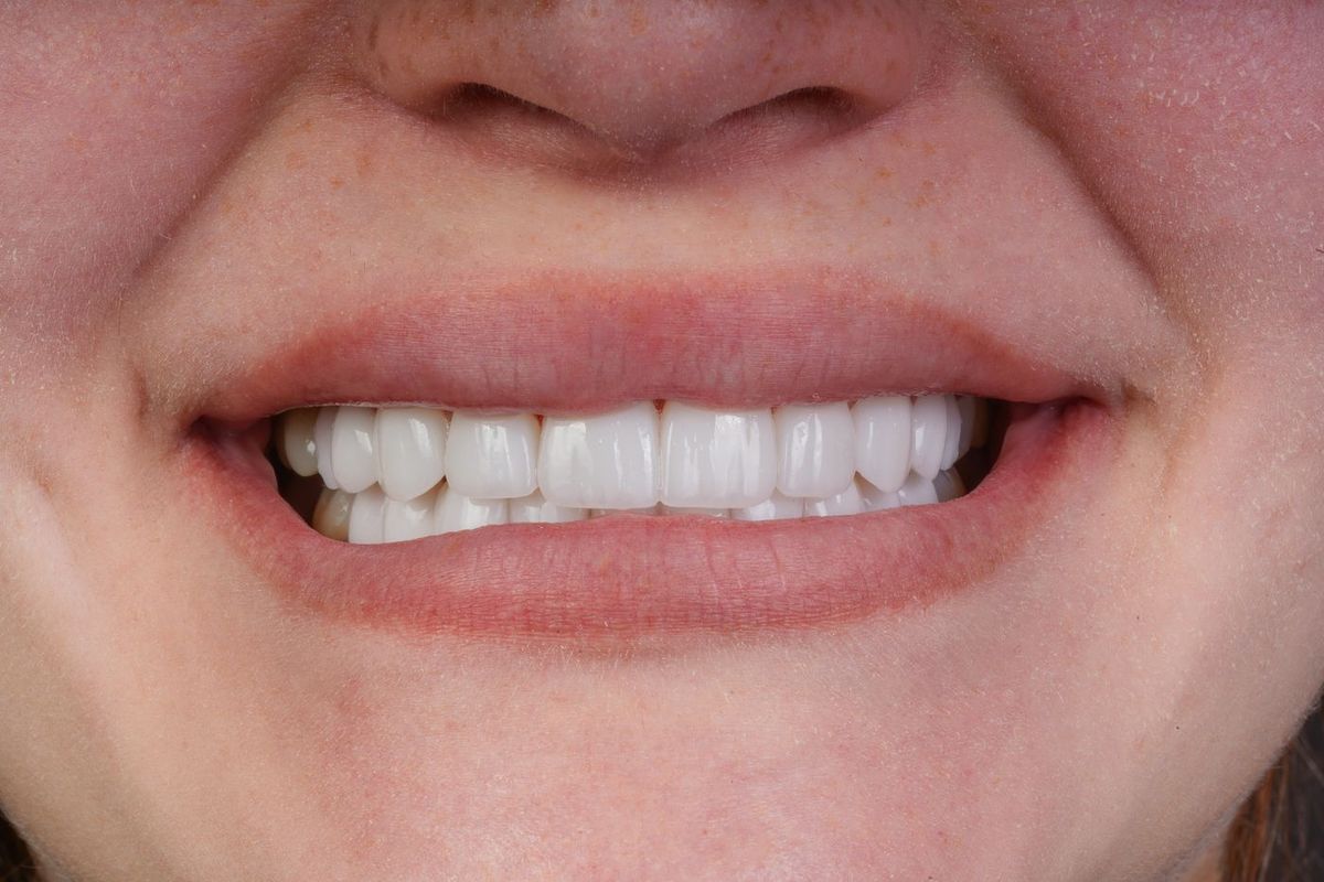 After Porcelain Veneers