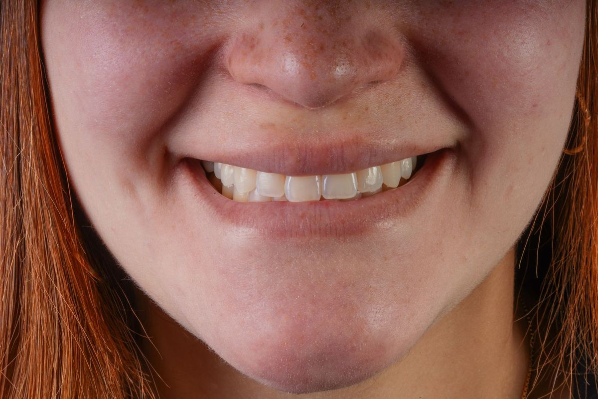 Before Porcelain Veneers