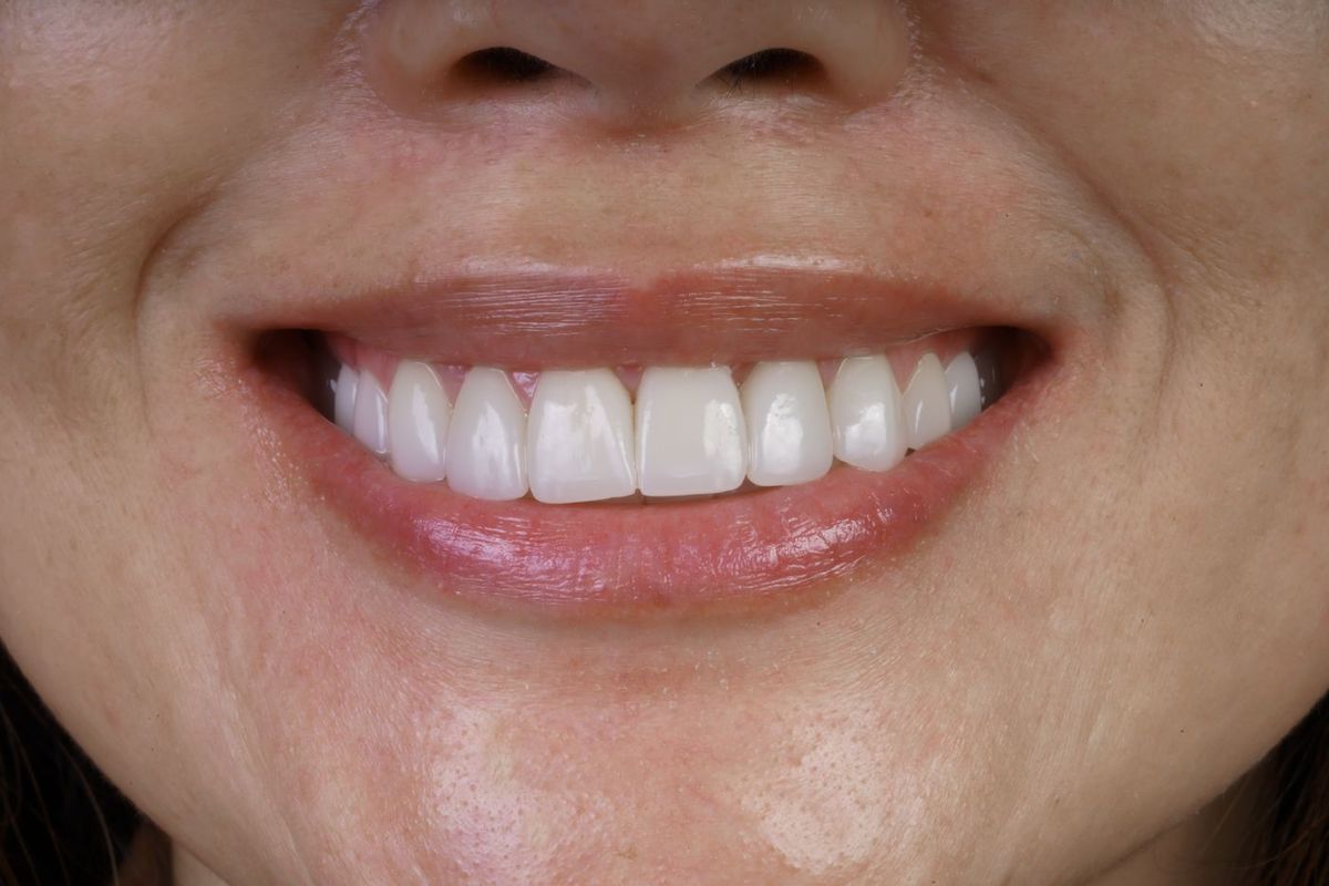 After Porcelain Veneers