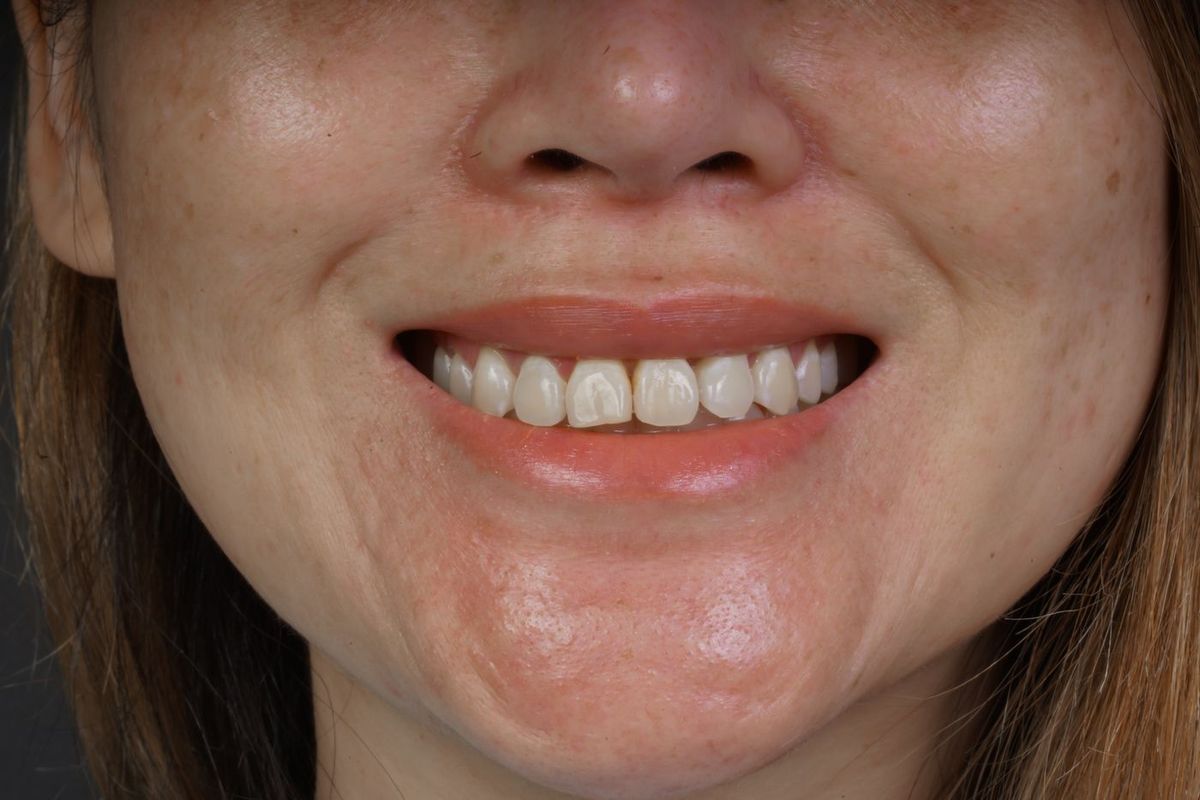 Before Porcelain Veneers