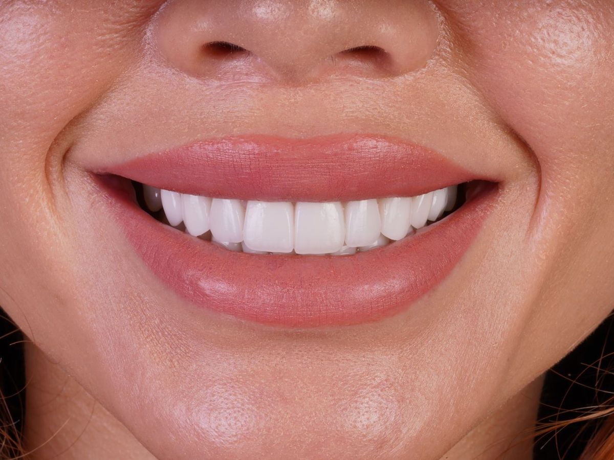 After Porcelain Veneers
