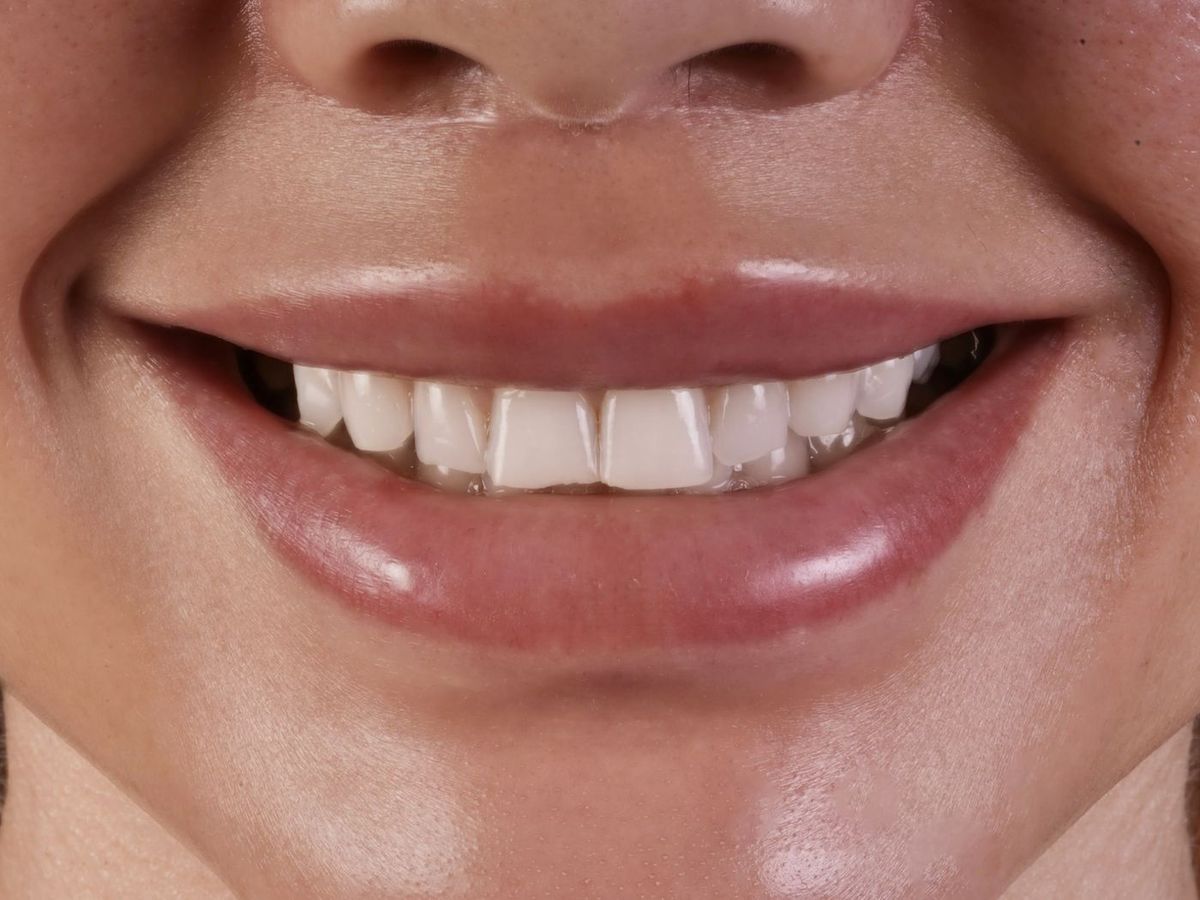 Before Porcelain Veneers
