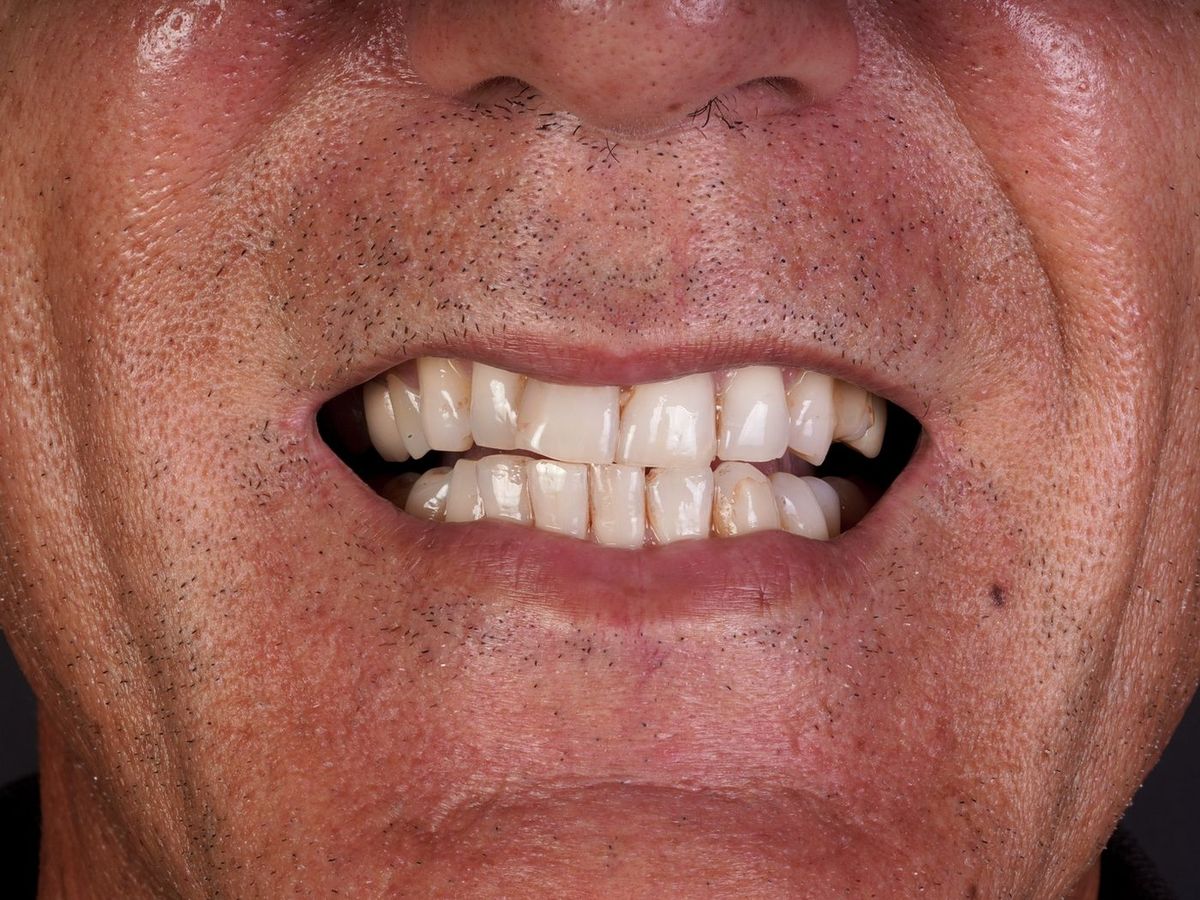 Before Porcelain Veneers