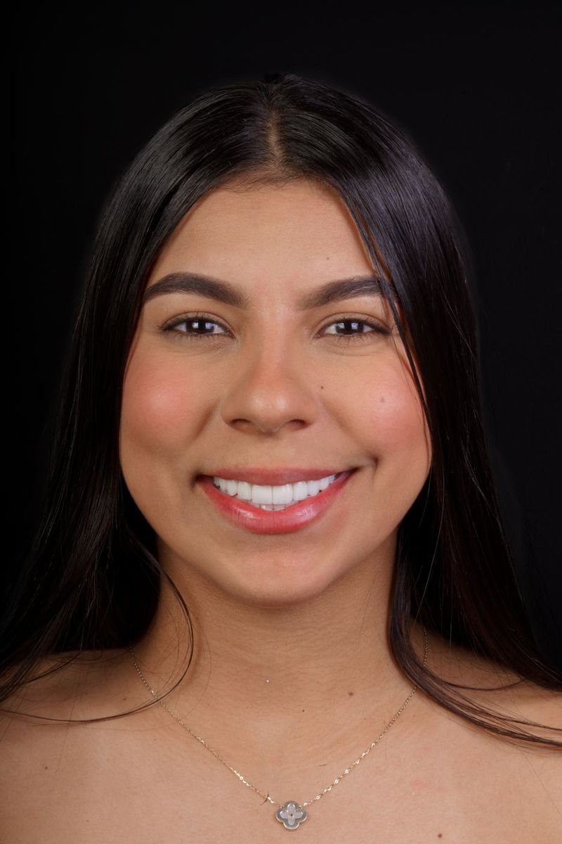 Before Porcelain Veneers