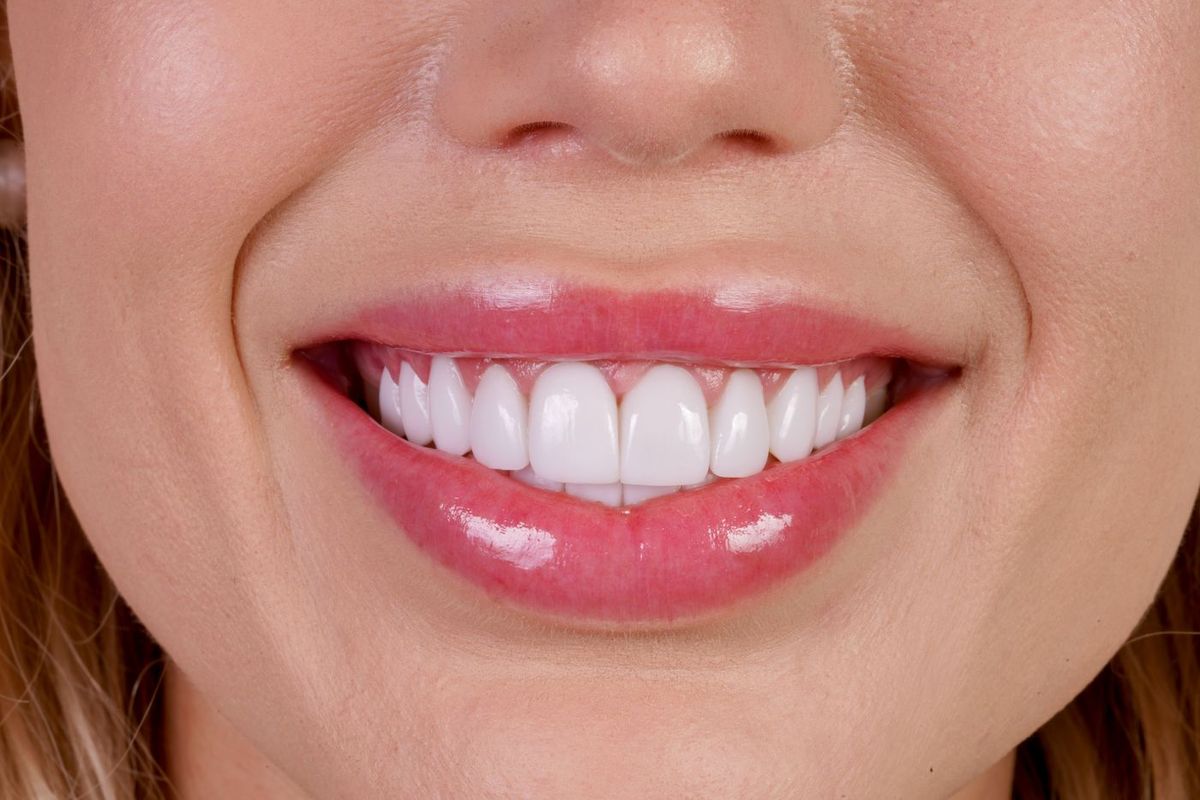 After Porcelain Veneers
