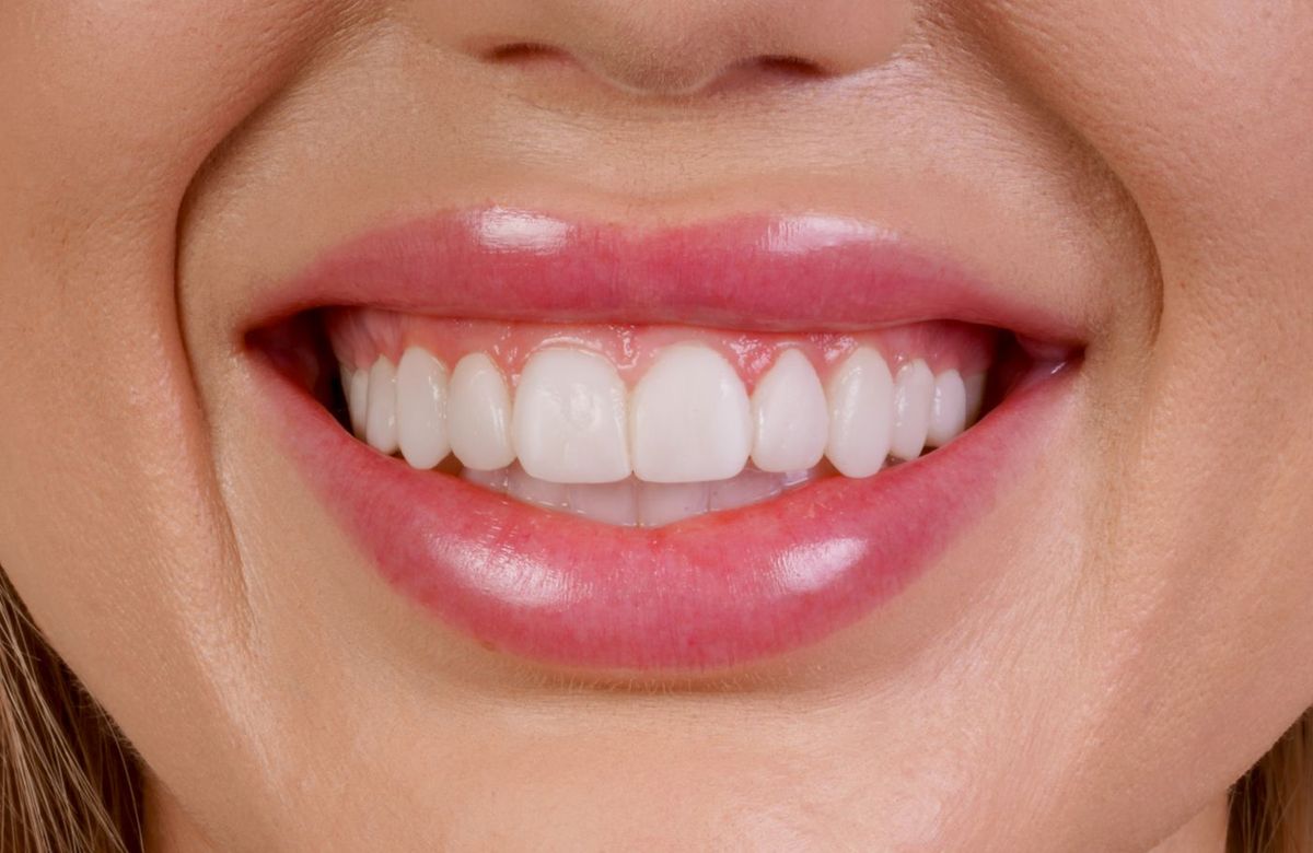 Before Porcelain Veneers
