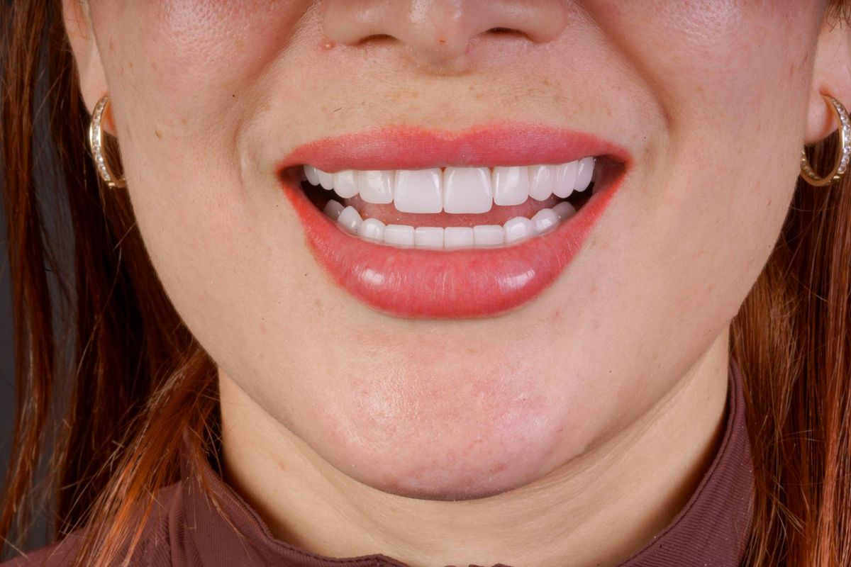 After Porcelain Veneers