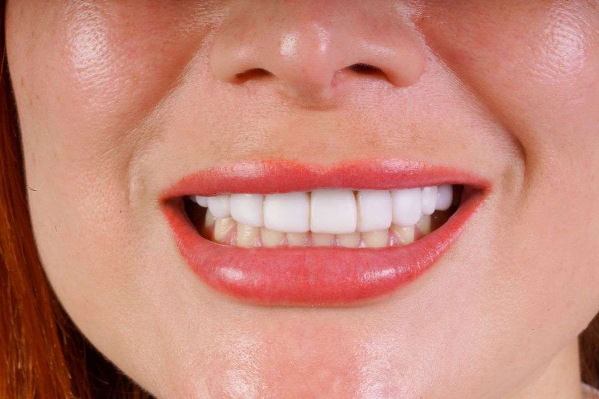 Before Porcelain Veneers