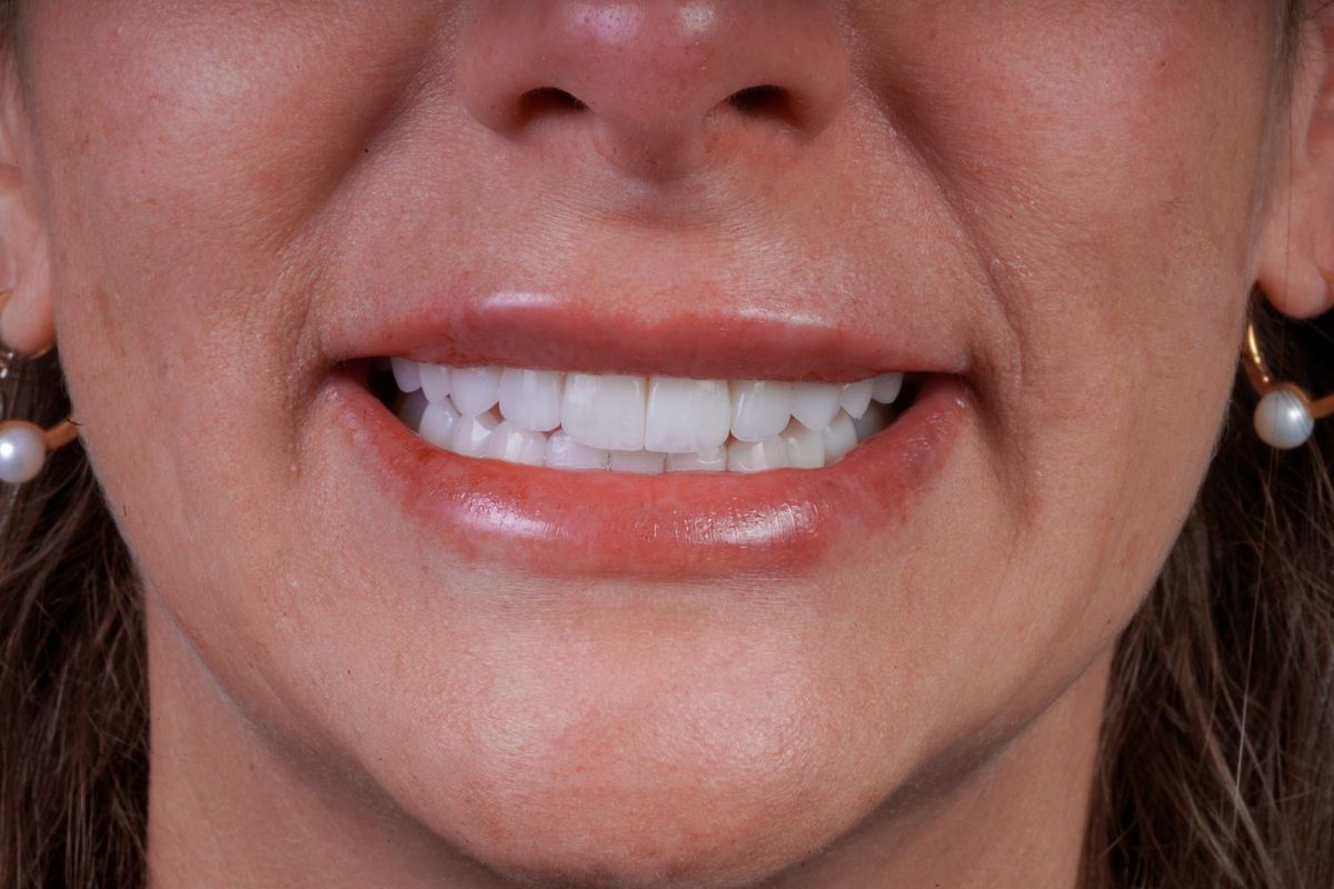 After Porcelain Veneers