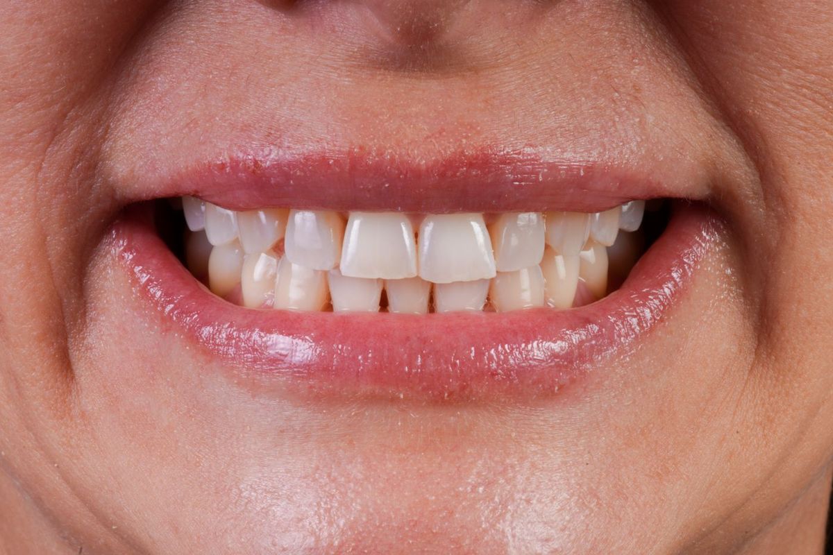 Before Porcelain Veneers