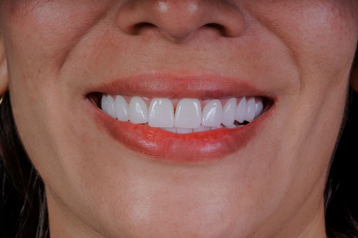 After Porcelain Veneers