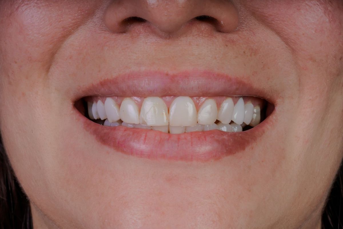 Before Porcelain Veneers