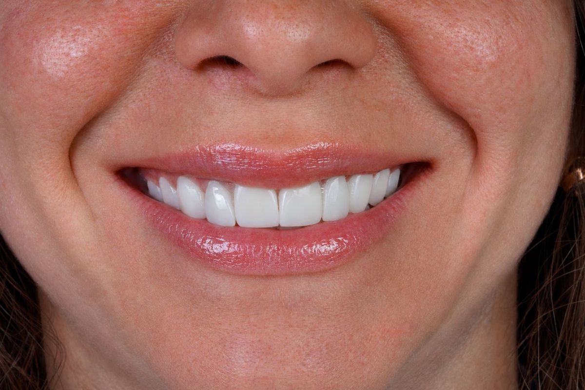 After Porcelain Veneers